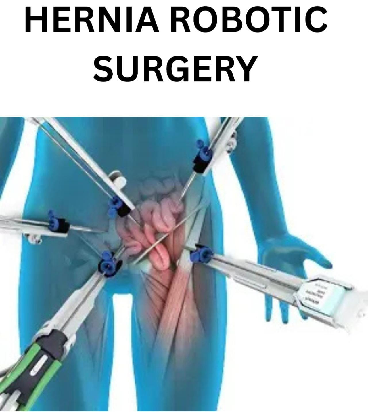 Hernia Treatment