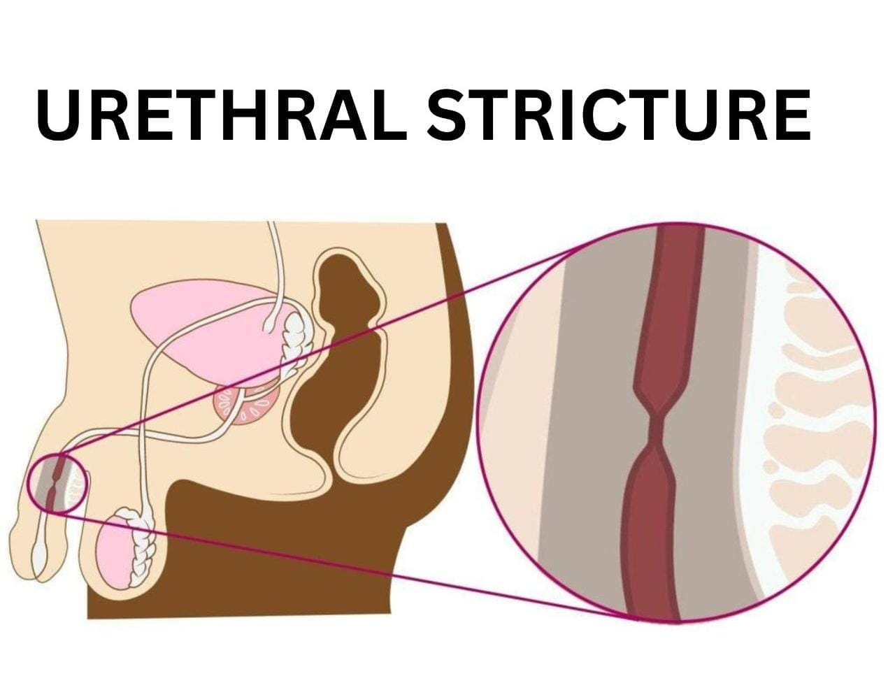 Urethroplasty Treatment